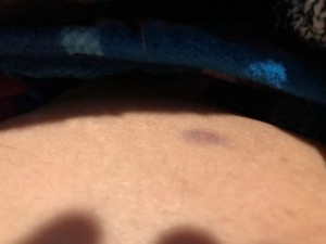 My first tiny bruise- this can happen after IVF injections
